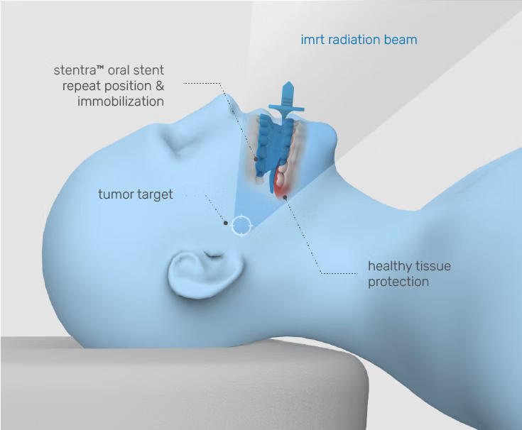 Stentra radiation beam