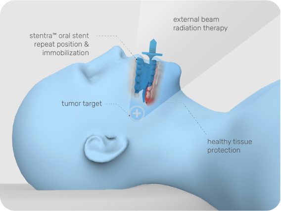 Stentra protects healthy tissues and the tong from radiation