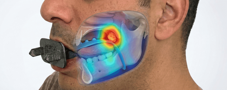 A profile view of a person using the Kallisio Stentra intraoral positioning system. The image features a semi-transparent anatomical overlay showing the device positioning the tongue and soft tissues within the mouth and jaw. A heatmap overlay indicates the targeted radiation treatment area for head and neck cancer.